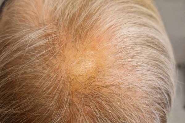 Alopecia areata